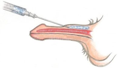 Insertion of polymeric materials to thicken the penis