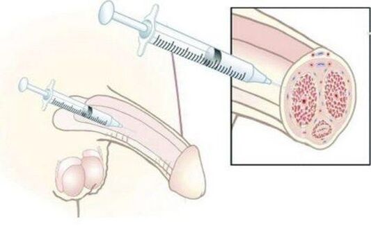 Ingrediment of hyaluronic acid injections