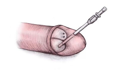 The head of the penis can be enlarged by injecting hyaluronic gel