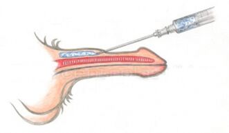Hyaluronic acid injection into the penis